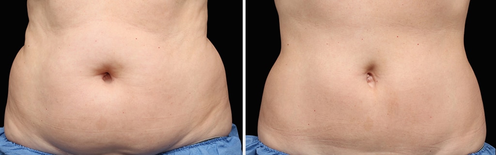 Results of Coolsculpting Treatment