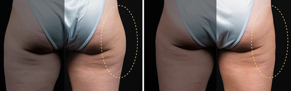 Results of Coolsculpting Treatment