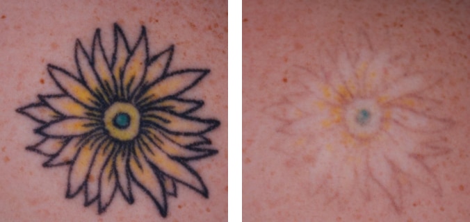 Laser Tattoo Removal Treatment Result